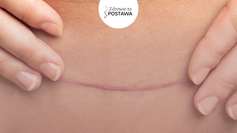 Cesarskie cięcie co musisz wiedzieć? Fizjoterapia uroginekologiczna Komorniki