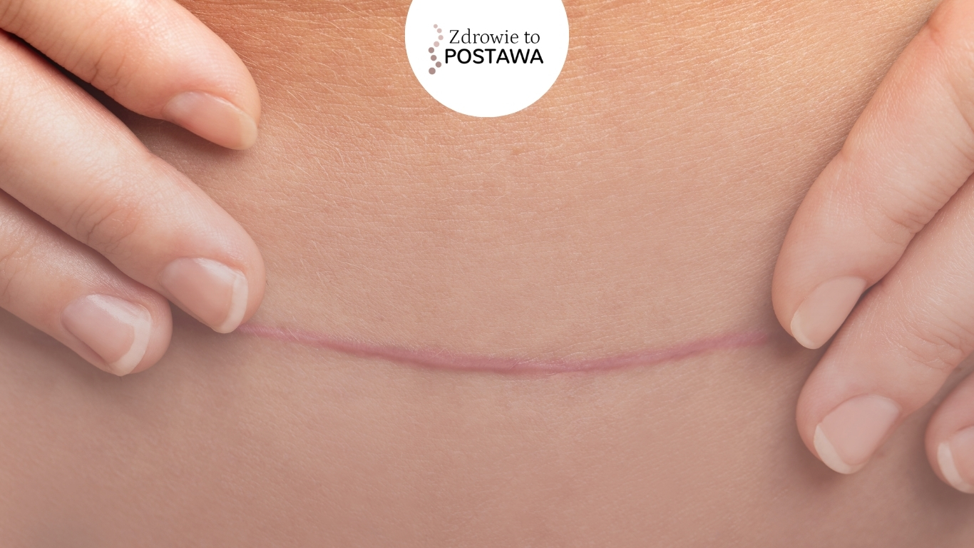 Cesarskie cięcie co musisz wiedzieć? Fizjoterapia uroginekologiczna Komorniki