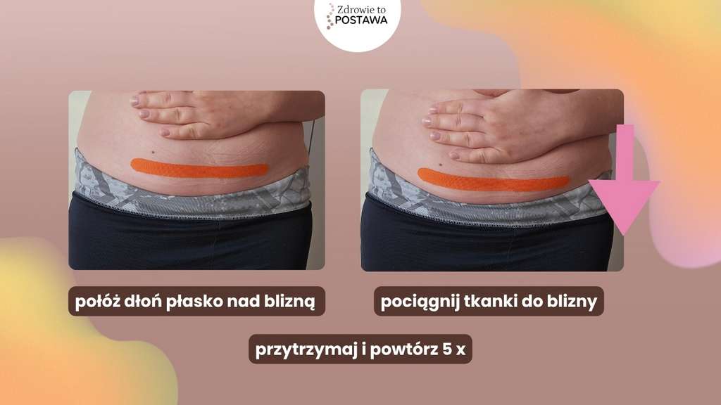 Masaż blizny fizjoterapia uroginekologiczna Komorniki Poznań