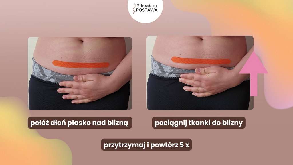 Masaż blizny fizjoterapia uroginekologiczna Komorniki Poznań